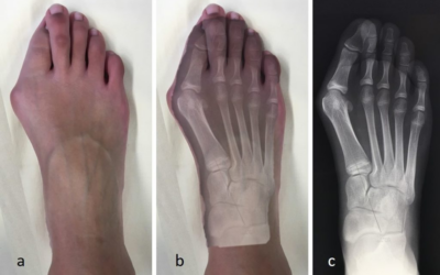 Hallux Valgus – Comprendre, évaluer et traiter – 1er et 2 décembre 2026